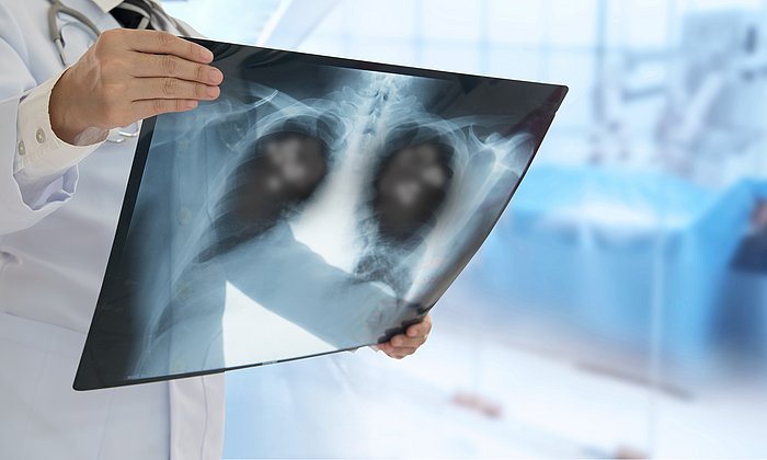 X-ray image of a lung
