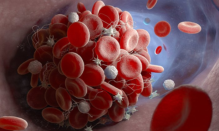 Sars-CoV-2 infection causes thrombocytes to attach to the blood platelets. This creates cell aggregates in the bloodstream.