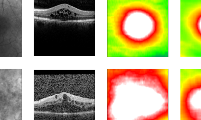 Algorithm predicts retinal thickness.