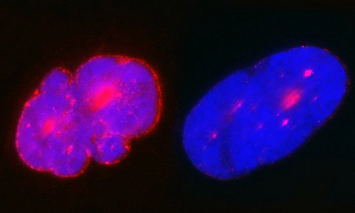 Das Bild zeigt zwei Zellkerne mit menschlicher DNA (blau). Aufgrund der großen Menge an Progerin (rot) verformen sich die Kerne in Zellen von HGPS-Patienten (links) im Vergleich zu normalen Kernen (rechts), die nur sehr wenig Progerin enthalten. (Bild: K. Djabali / TUM)