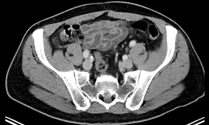 CT-Aufnahme eines Beckens ohne auffällige Lymphknoten. (Foto: Nuklearmedizin / TUM)