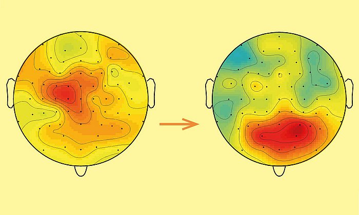 Das Bild zeigt die EEG-Ergebnisse während eines kurzen (links) und eines langandauernden Schmerzreizes (rechts). Die Hirnbereiche mit der stärksten Aktivität erscheinen rot. Kurzer Schmerz wird in sensorischen Bereichen verarbeitet, langandauernder Schmerz eher in emotionalen Hirnbereichen in der Stirnregion. (Bild: E. Schulz et al., 2015, Prefrontal gamma oscillations encode tonic pain in humans, Cerebral Cortex, doi10.1093/cercor/bhv043, modifiziert)