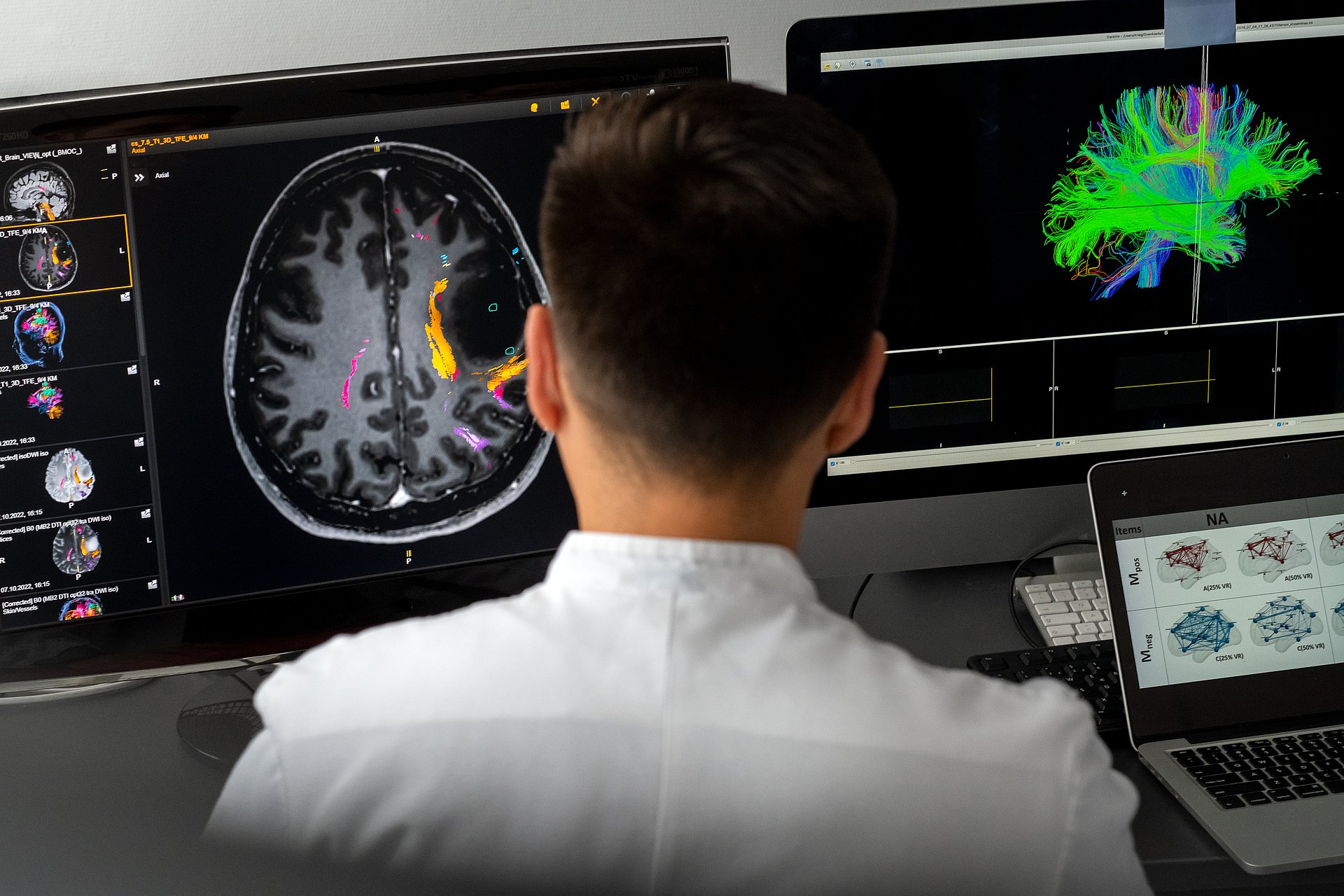 Gliom Connectom Analysis: die Arbeitsgruppe funktionelle Neuronavigation und -monotoring von Prof. D.r med. Sandro Krieg an der Neurochirurgischen Klinik der Technischen Universitaet Muenchen (TUM) am Klinikum rechtss der Isar, kartiert preaoperativ den B Forscher sitzt vor zwei Bildschirmen und macht eine