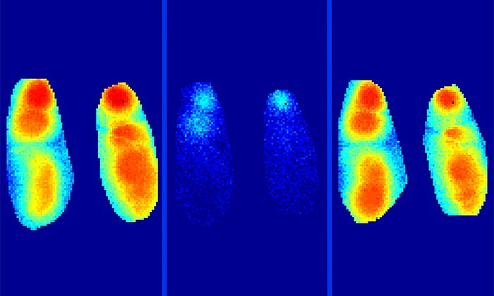 Image representing the slow waves in the brain, which spread out normally during sleep (left). This process is severely disrupted by the β -amyloid plaques (center). The disruption is reversed by administering a benzodiazepine (right). (Picture: Marc Aurel Busche / TUM)