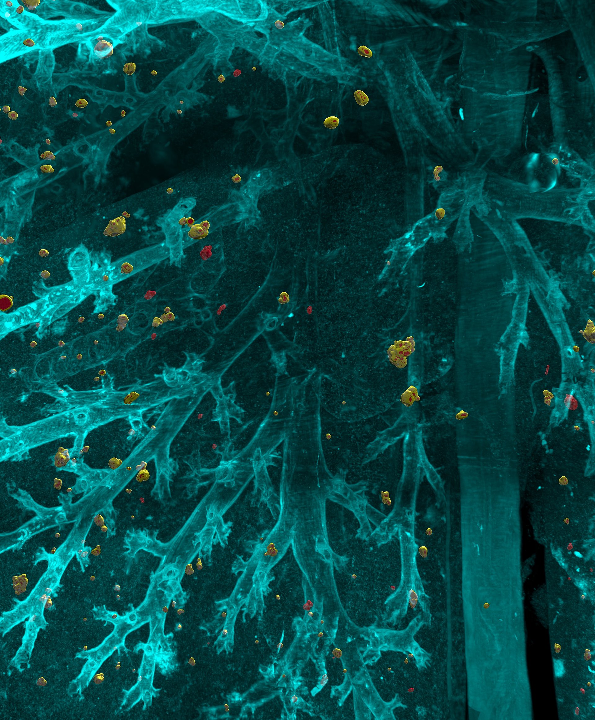 Computer illustration of metastases in body tissue