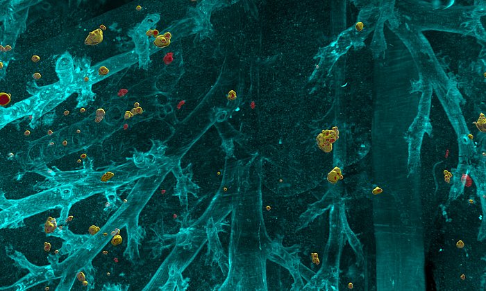 Computerillustration von Metastasen in Körpergewebe