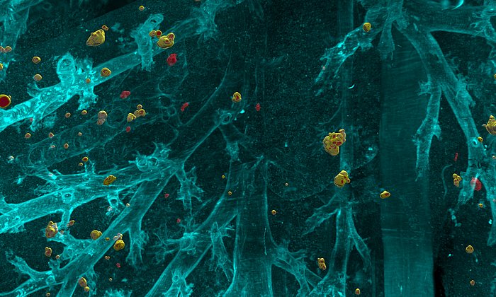 Computer illustration of metastases in body tissue