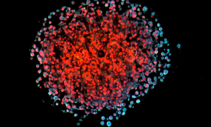 3D-Spheroid von Brustkrebszellen in Kultur. Die invasiven (metastasierenden) Zellen erscheinen durch überlappende Fluoreszensmarkierung des Leptin-Receptors und eines Metastasierungsmarkers hellblau. Zellkerne sind rot gefärbt. (Bild: Helmholtz Zentrum München)