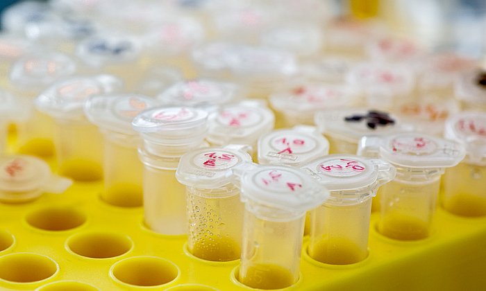In DNA-Proben von insgesamt elf Patienten fanden die Wissenschaftler Fehler im NBAS-Gen. (Foto: A. Heddergott / TUM)