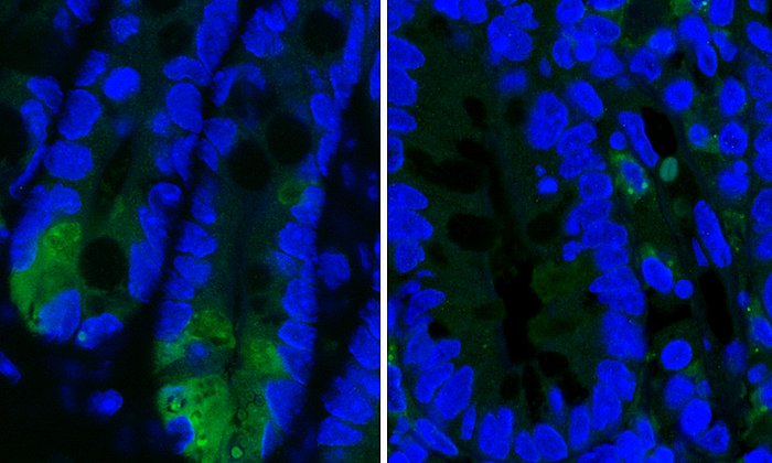 The images show Paneth cells in the small intestine. These cells play an important role in immune defense. In mice with Crohn’s-type inflammation, the Paneth cells produce less lysozyme, an important anti-microbial enzyme. Left: Healthy cells producing high levels of lysozyme (light green); right: Damaged Paneth cells producing low levels of lysozyme.