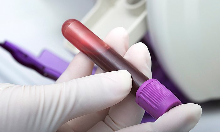 Eine Blutprobe in den Händen mit Laborhandschuhen. Einer neuer Biomarker im Blut könnte eine bessere Kontrolle für Therapien bei Herzvorhofflimmern liefern.
