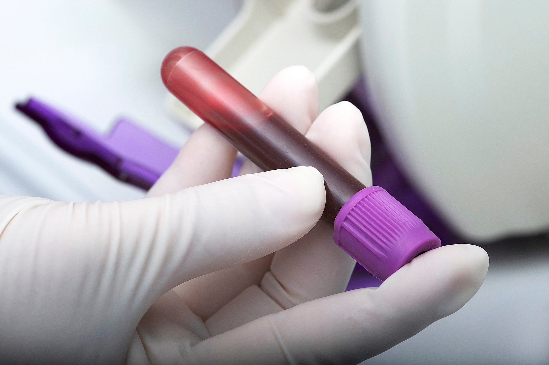 A new marker in the human blood provides better control of treatment for atrial fibrillation. A blood sample in hands with white gloves. A new marker in the human blood provides better control of treatment for atrial fibrillation.