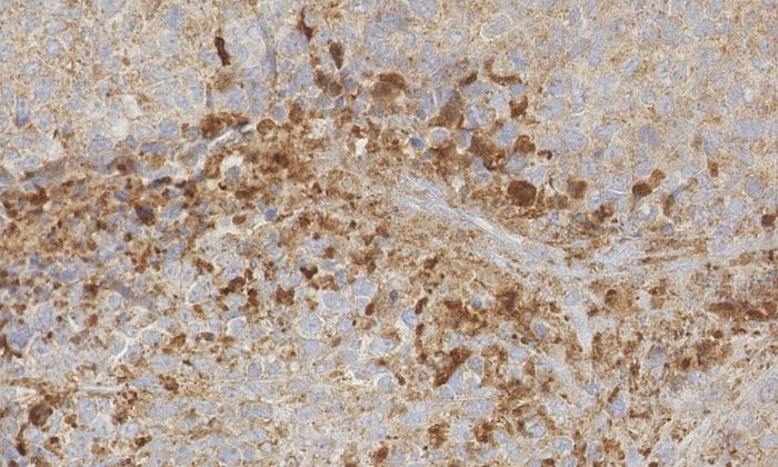 Ewing Sarkom in einer Maus nach dem Einsatz des Hemmstoffs JQ1 (Ausschnitt): Der beginnende Zelltod der Tumorzellen ist mit braunem Farbstoff kenntlich gemacht.
