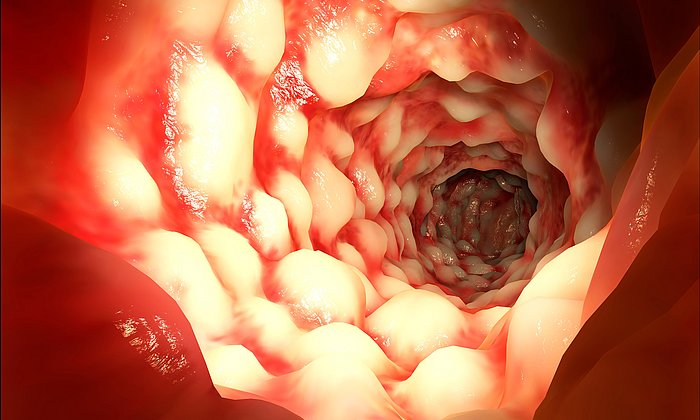 Ein Darm eines Patienten von innen, der an Morbus Crohn erkrankt ist. (Foto: Fotolia/ Juan Gärtner)