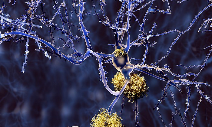 Ein Neuron mit Amyloid-Plaques. (Foto: Juan Gärtner/ Fotolia)