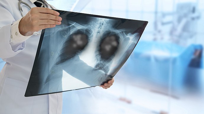 Röntgen-Aufnahme einer Lunge