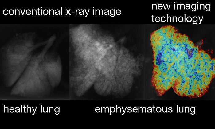 A combination of dark-field and conventional transmission information allows for a clear distinction of healthy versus emphysematous tissue and an assessment of the regional distribution of the disease. From such images, a doctor might in future not only see if a patient is diseased but also which parts of the lung are affected and how much. Picture: Simone Schleede / TUM