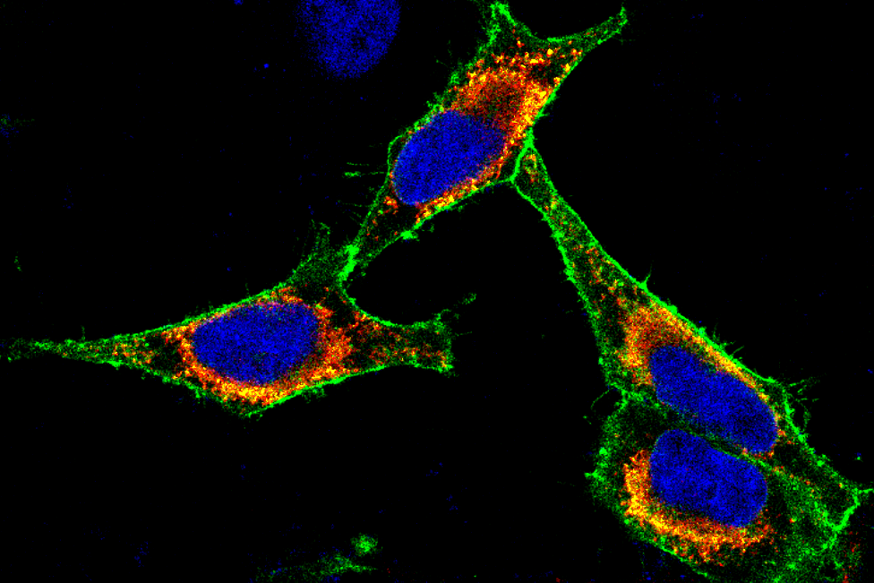 Immunofluorescence image of cancer cells in which a membrane protein has been labeled with a green fluorescent dye. The nucleus is marked with a blue dye.