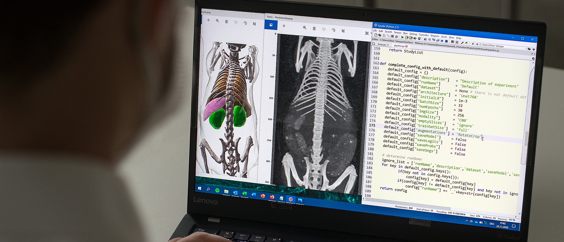 Dank künstlicher Intelligenz ist die AIMOS-Software in der Lage, auf dreidimensionalen Graustufenbildern Knochen und Organe zu segmentieren, was die anschließende Auswertung erheblich erleichtert.
