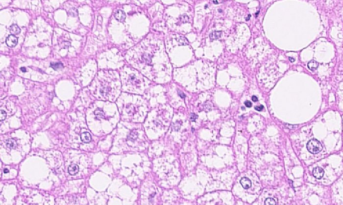 The picture shows a histological tissue slice of a steatoheaptitis in human liver tissue. (Picture: A. Weber / Universitätsspital Zürich, explanation see below)