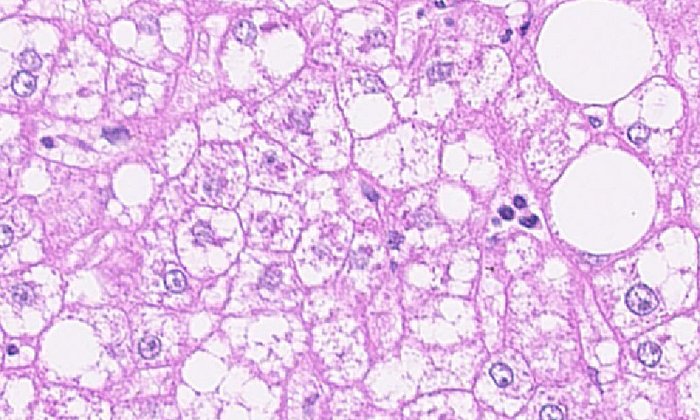 Die Abbildung zeigt einen histologischen Gewebeschnitt einer Steatoheaptitis im Menschen. (Bild: A. Weber / Universitätsspital Zürich, Erklärung s. unten)