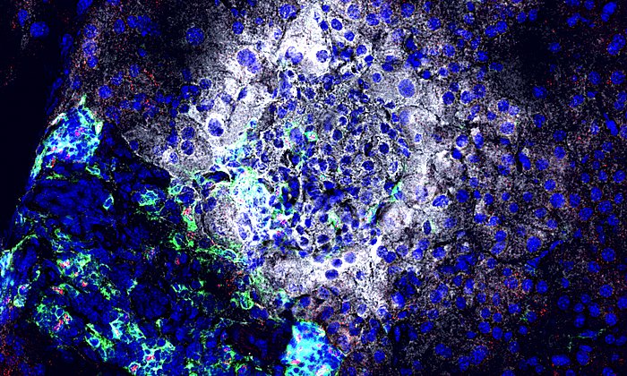 Treatment with an Antagomir directed against miR92a results in reduced attacks of immune cells (green) on the insulin (white) producing beta cells directly in the pancreas. Moreover, the treatment leads to more regulatory T cells (red) able to protect the beta cells. (Photo: Helmholtz Zentrum Munich)