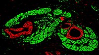 Immunofluorescence image of pancreatic cancer