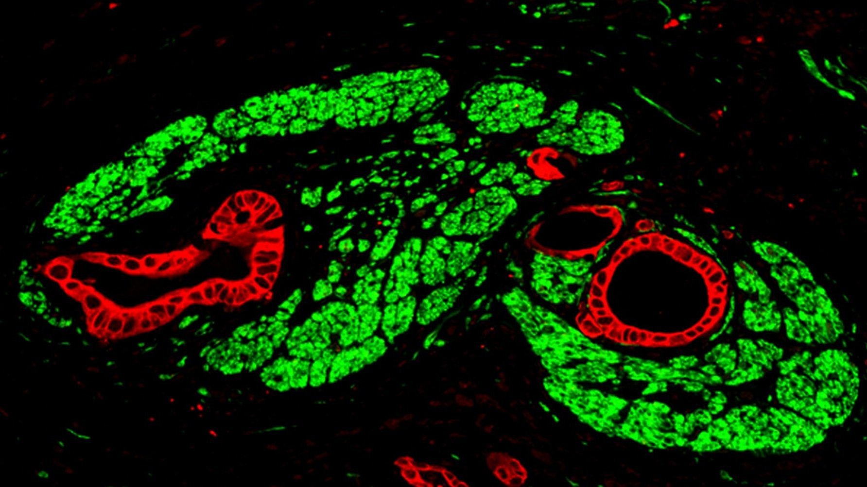 Immunofluorescence image of pancreatic cancer