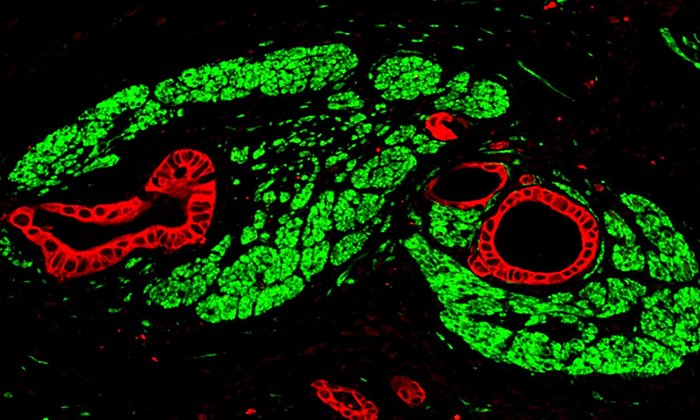  Immunofluoreszenz-Aufnahme von Bauchspeicheldrüsenkrebs