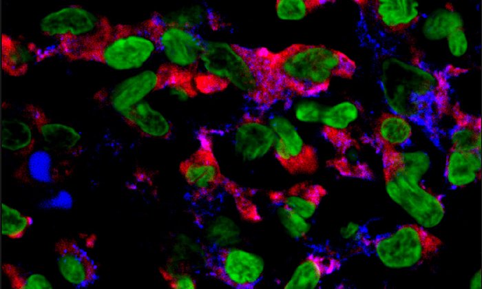 The picture shows cells in human psoriatic skin lesions of psoriasis patients before IL-4 therapy. The signaling molecule IL-23 was stained with a red dye, the cell nuclei with a green one. (Picture: E. Guenova, Y. Skabytska, W. Hoetzenecker, G. Weindl, K. Sauer, M. Tham, K.-W. Kim, J.-H. Park, J. H. Seo, D. Ignatova, A. Cozzio, M. P. Levesque, T. Volz, M. Köberle, S. Kaesler, P. Thomas, R. Mailhammer, K. Ghoreschi, K. Schäkel, B. Amarov, M. Eichner, M. Schaller, R. A. Clark, M. Röcken, und T. Biedermann, IL-4 abrogates TH17 cell-mediated inflammation by selective silencing of IL-23 in antigen-presenting cells, PNAS, Feb 2015, 112(7), 2163–2168, doi: 10.1073/pnas.1416922112.)