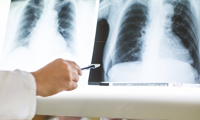 In Röntgen-Aufnahmen lassen sich Schädigungen der Lunge durch Covid-19 identifizieren. 