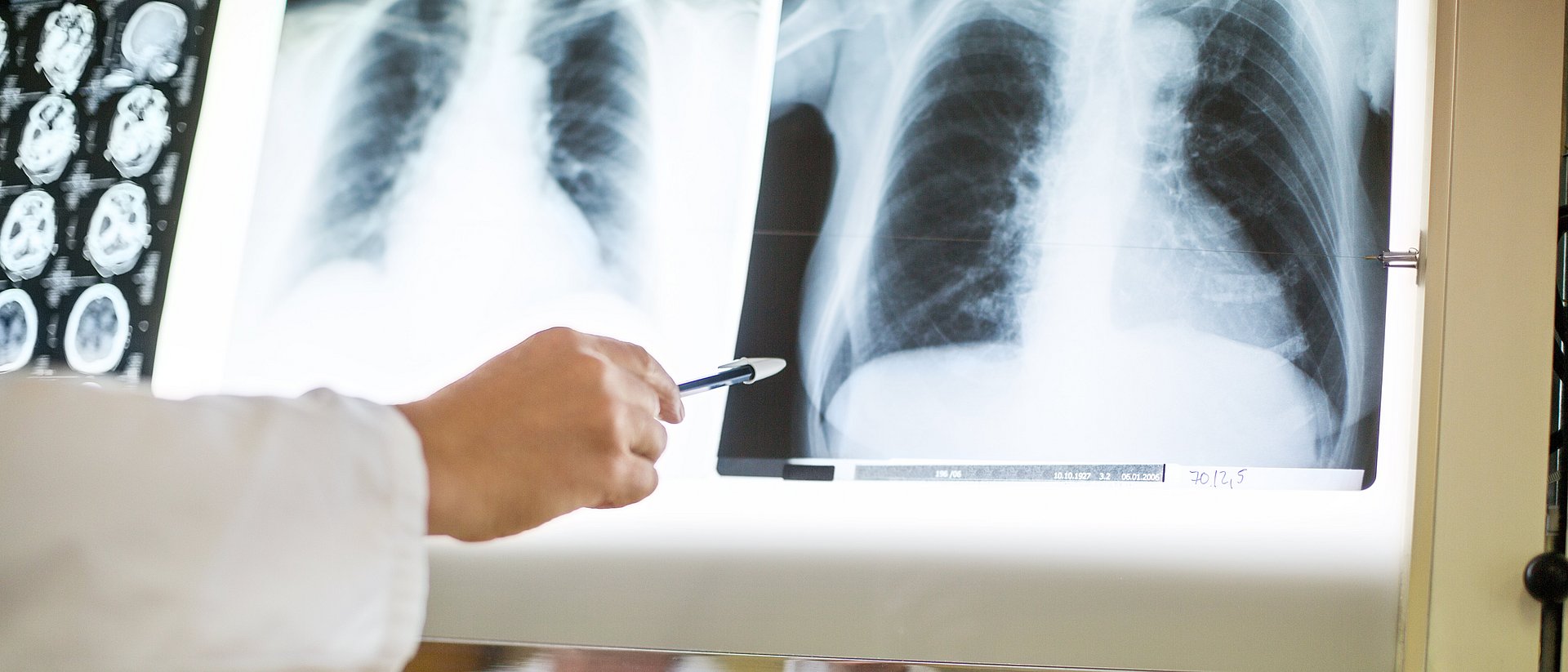 In Röntgen-Aufnahmen lassen sich Schädigungen der Lunge durch Covid-19 identifizieren. 