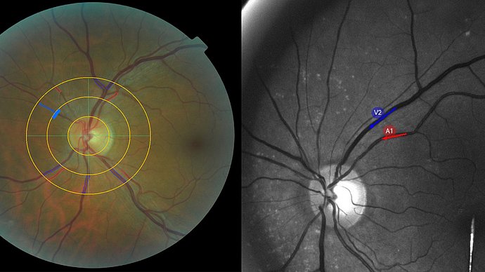 Two images from eye examinations