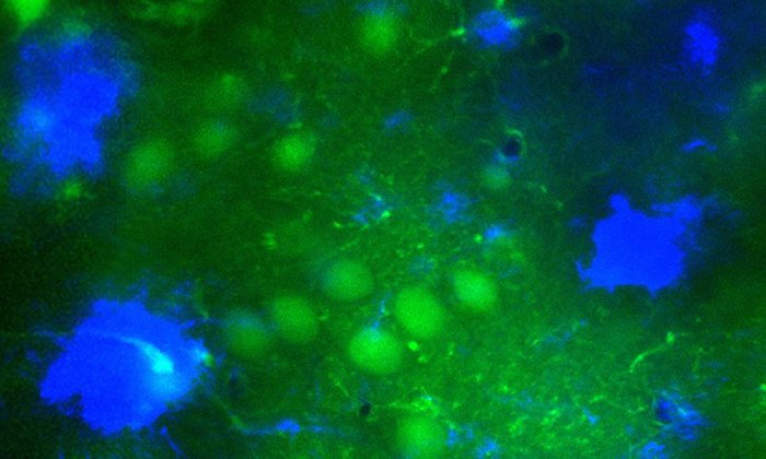 Mikroskopischer Einblick ins Alzheimer-Gehirn mit grün fluoreszierenden Nervenzellen in der Nähe der typischen Amyloid-Plaques (in blau dargestellt). (Bild: M. A. Busche / TUM)