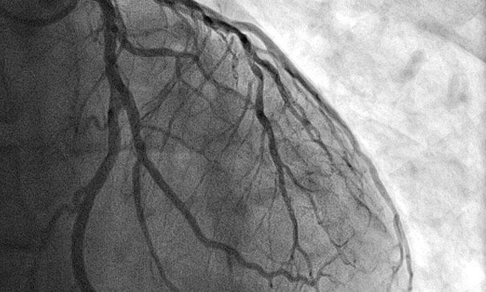 Aufnahme der Blutgefäße auf einem Herzmuskel.