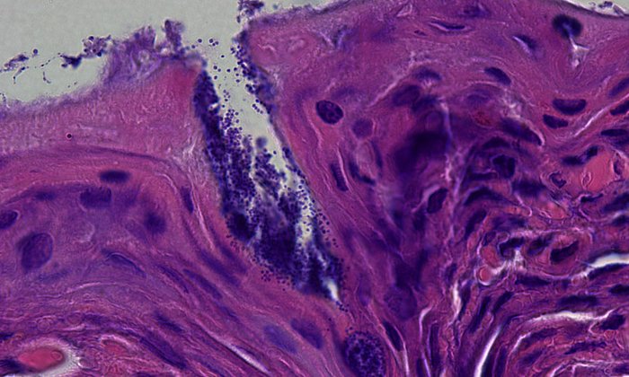 Auf der Abbildung ist die Haut eines Patienten mit Neurodermitis zu sehen (histologische Färbung), die mit Staphylococcus aureus Bakterien (dunkle Punkte auf der Oberfläche und in der Kerbe) bedeckt ist. (Bild: Y. Skabytska / Universität Tübingen)