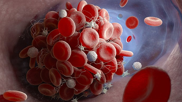Bei einer Sars-CoV-2 Infektion lagern sich Thrombozyten an den Blutplättchen an. Dadurch entstehen Zellaggregate im Blutkreislauf.