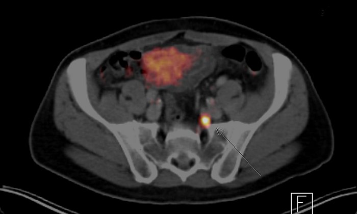 PET/CT-Aufnahme eines Beckens. Hell hervorgehoben ist ein Lymphknoten mit Metastasen. (Foto: Nuklearmedizin / TUM)