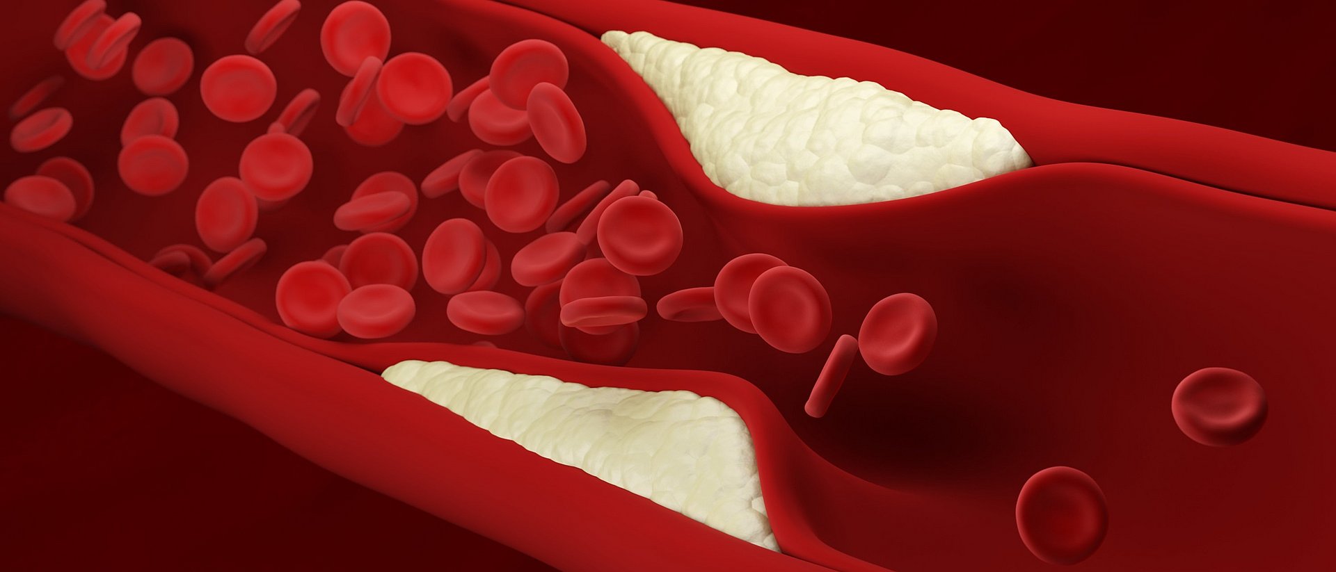 Illustration des Blutflusses durch eine verengte Arterie.