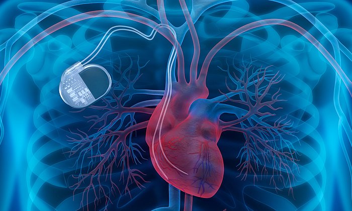 Illustration of an implanted defibrillator