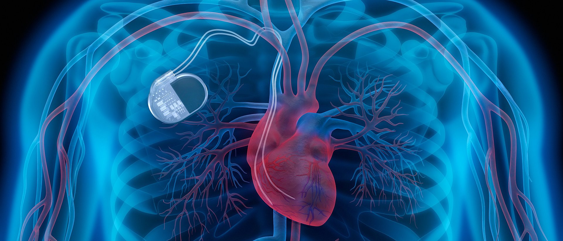 Illustration of an implanted defibrillator