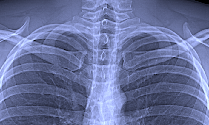 Conventional chest x-ray