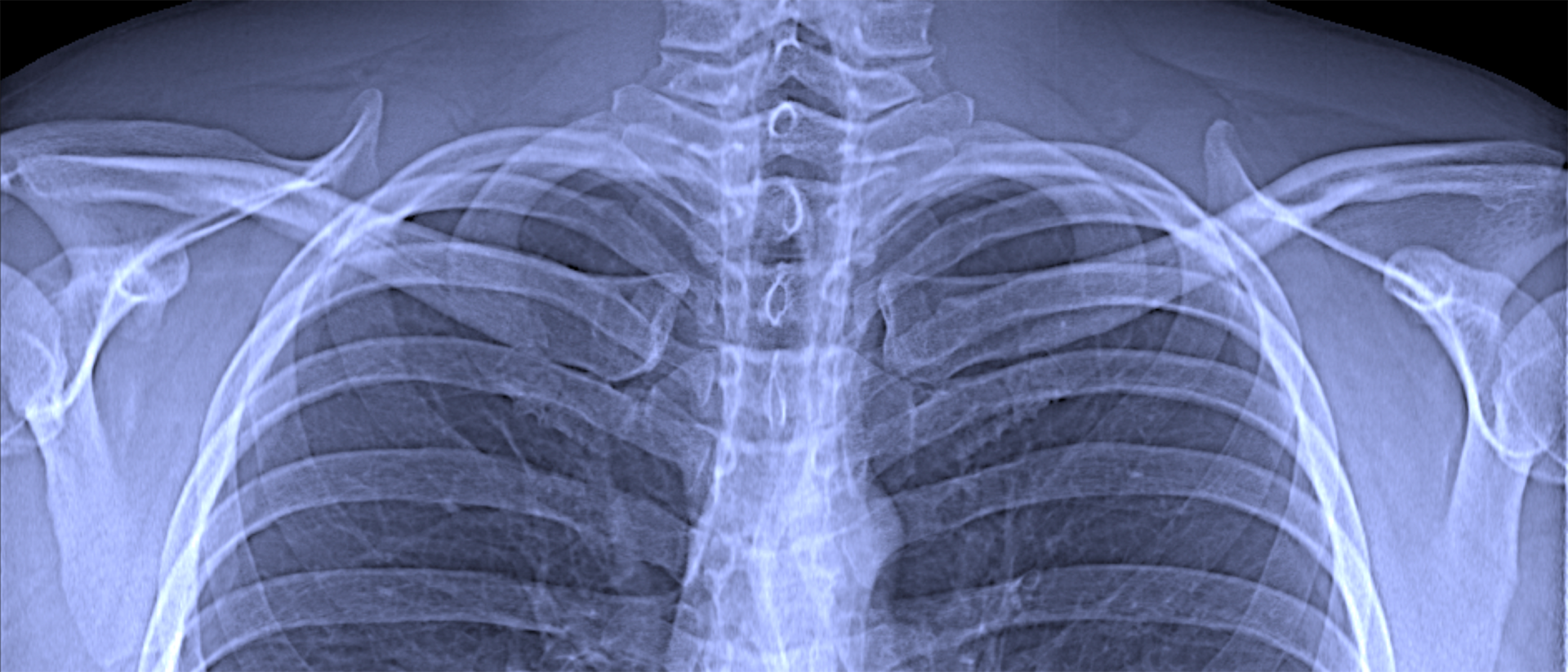 Conventional chest x-ray