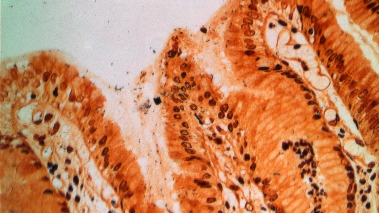 Microscopic image of stomach tissue infected with Helicobacter pylori.