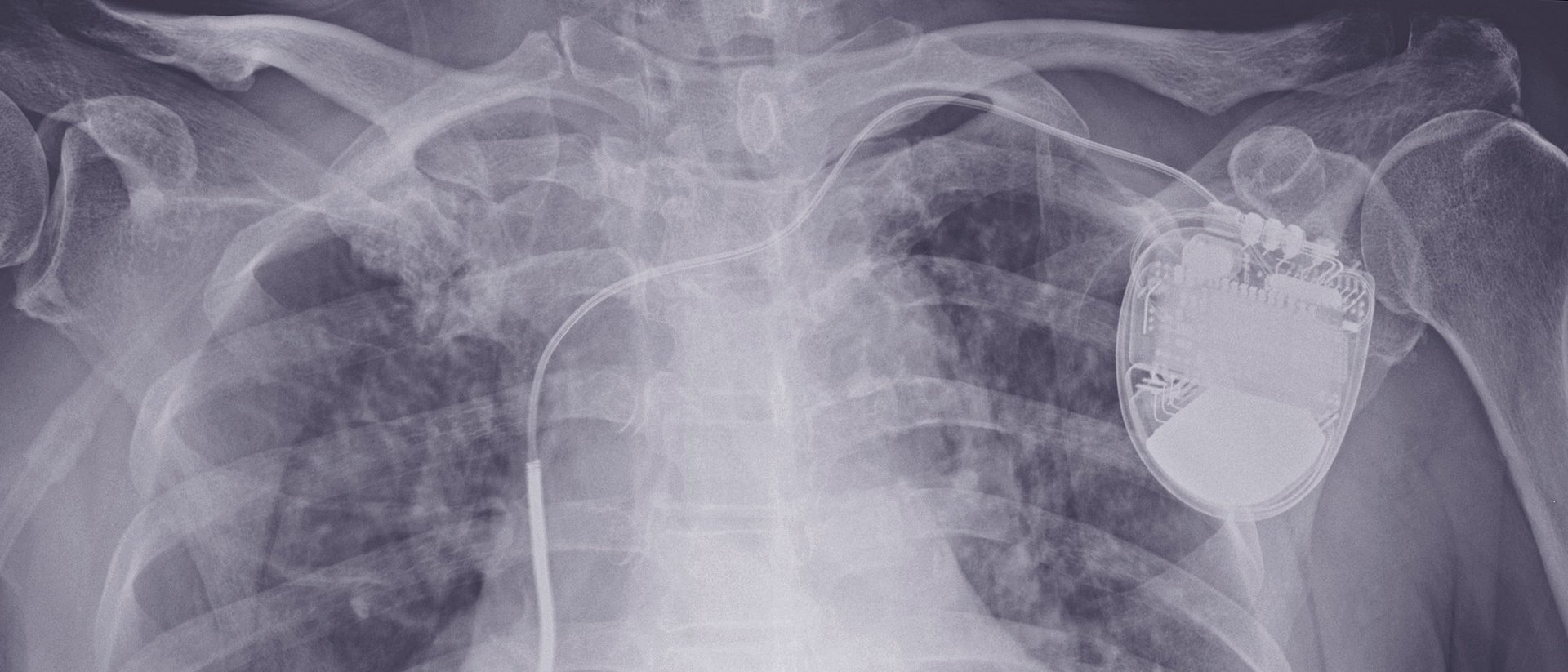 Röntgenbild eines Patienten mit implantiertem Defibrillator.