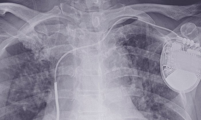 An x-ray image of a patient with an implanted defibrillator