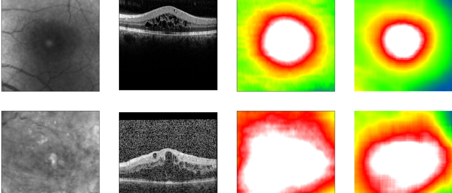 Algorithm predicts retinal thickness. Algorithm predicts retinal thickness.