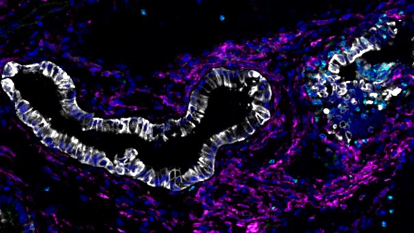 Pancreatic cancer cells.