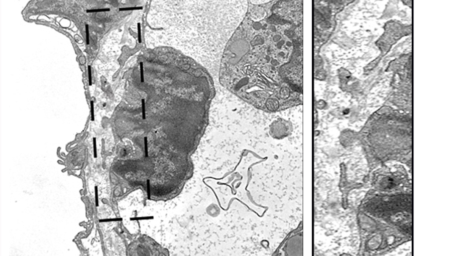 The picture shows a tumor cell that migrates through the wall of a blood vessel into the neighboring tissue.