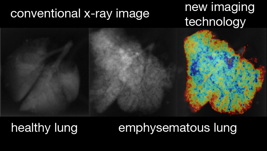 A combination of dark-field and conventional transmission information allows for a clear distinction of healthy versus emphysematous tissue and an assessment of the regional distribution of the disease. From such images, a doctor might in future not only see if a patient is diseased but also which parts of the lung are affected and how much. Picture: Simone Schleede / TUM